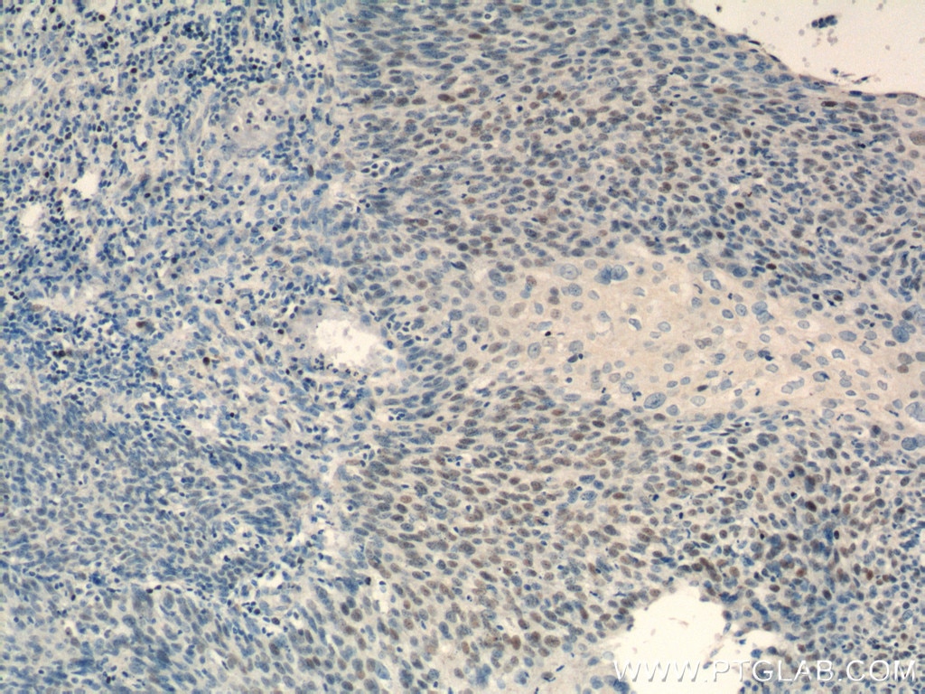 Immunohistochemistry (IHC) staining of human cervical cancer tissue using USP1 Monoclonal antibody (66069-1-Ig)