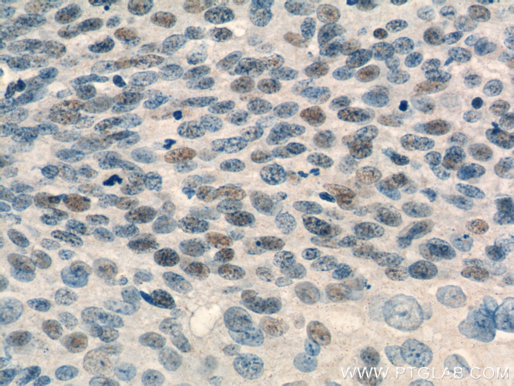 Immunohistochemistry (IHC) staining of human cervical cancer tissue using USP1 Monoclonal antibody (66069-1-Ig)