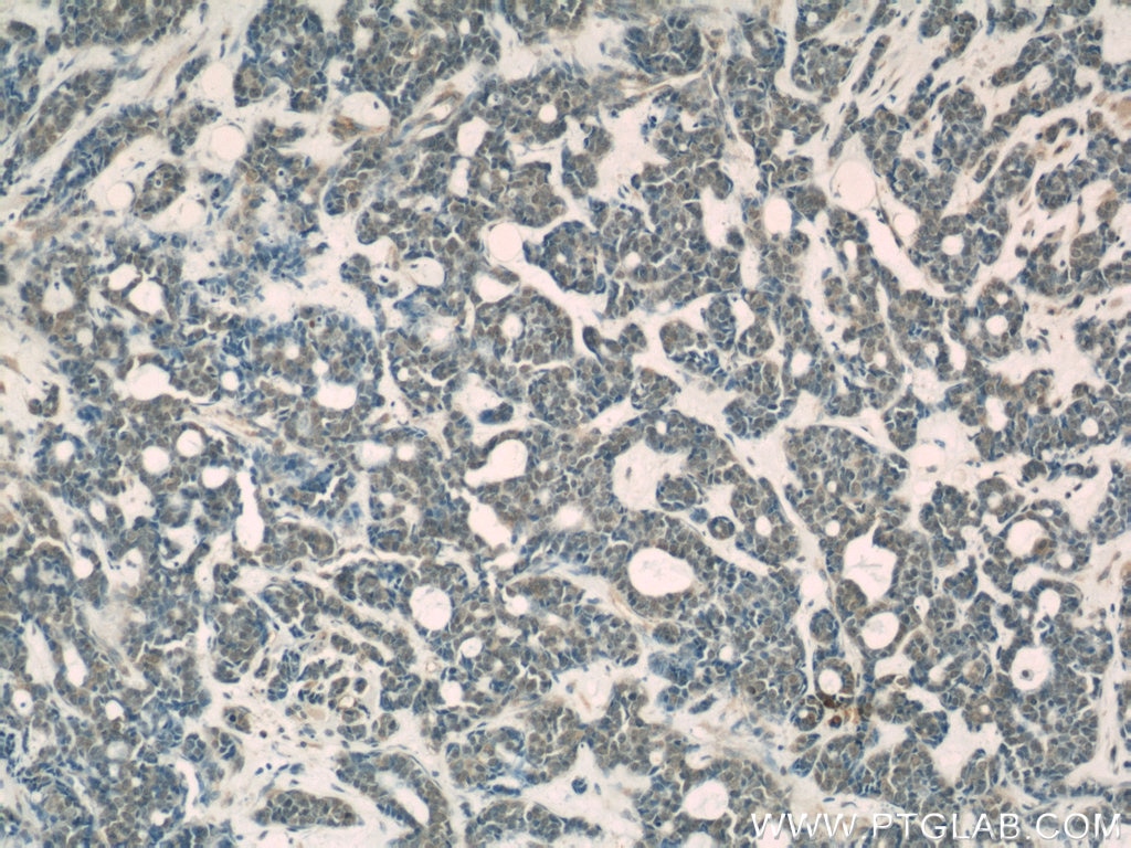 Immunohistochemistry (IHC) staining of human cervical cancer tissue using USP1 Monoclonal antibody (66069-1-Ig)