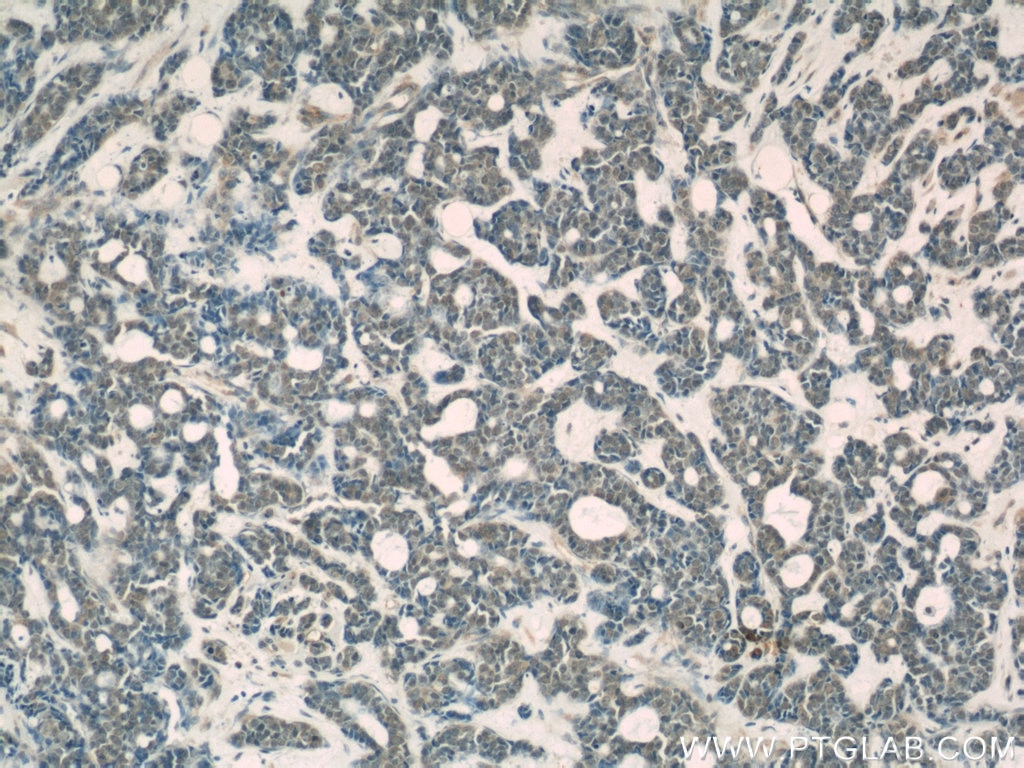 IHC staining of human cervical cancer using 66069-1-Ig