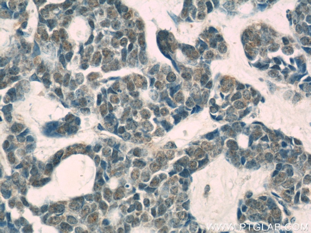 IHC staining of human cervical cancer using 66069-1-Ig