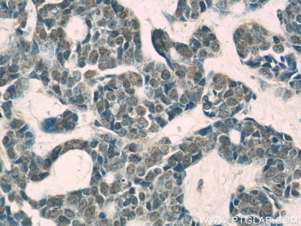 Immunohistochemistry (IHC) staining of human cervical cancer tissue using USP1 Monoclonal antibody (66069-1-Ig)