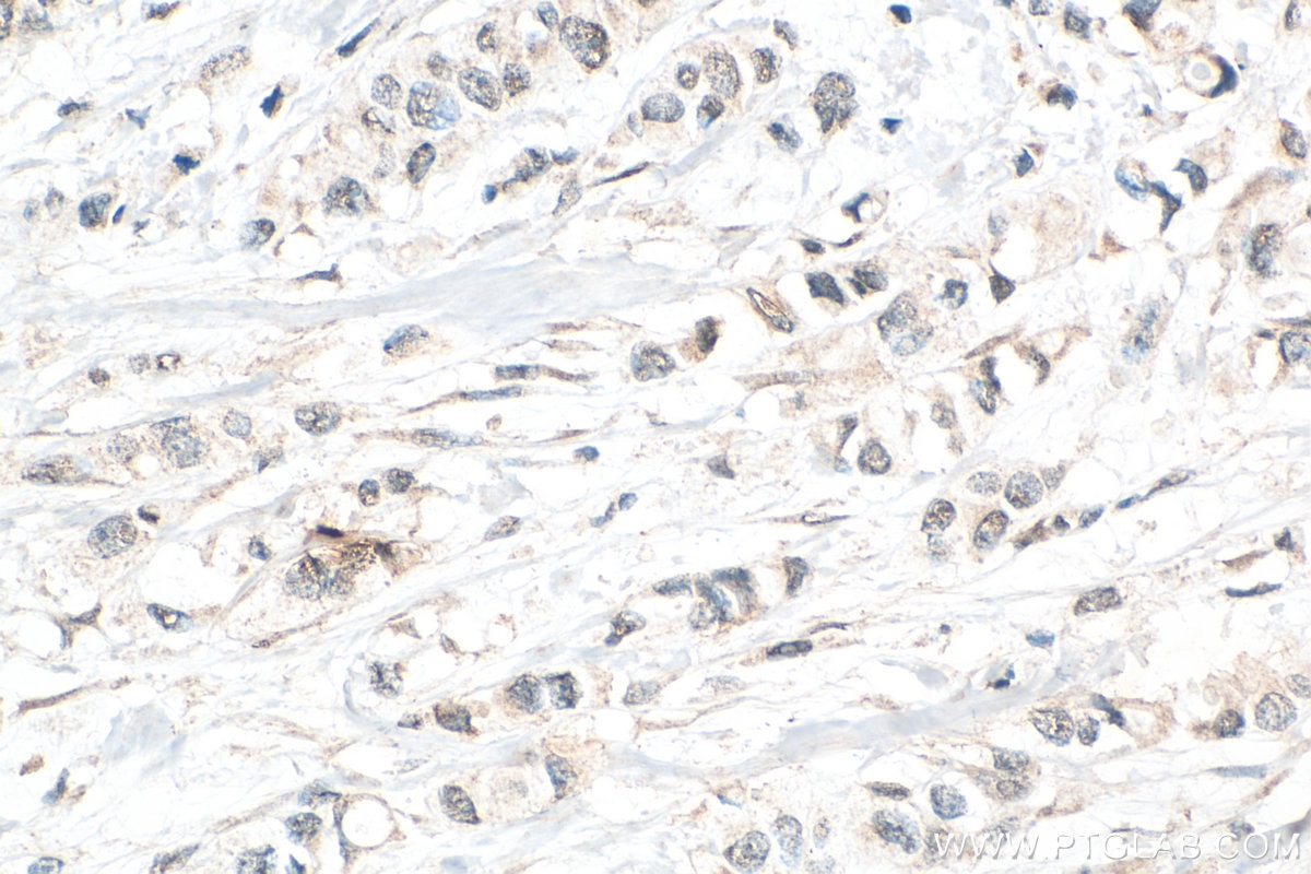 Immunohistochemical analysis of paraffin-embedded human breast cancer tissue slide using 19374-1-AP (USP10 antibody) at dilution of 1:200 (under 40x lens). Heat mediated antigen retrieval with Tris-EDTA buffer (pH 9.0). Immunohistochemistry (IHC) staining of human breast cancer tissue using USP10 Polyclonal antibody (19374-1-AP)