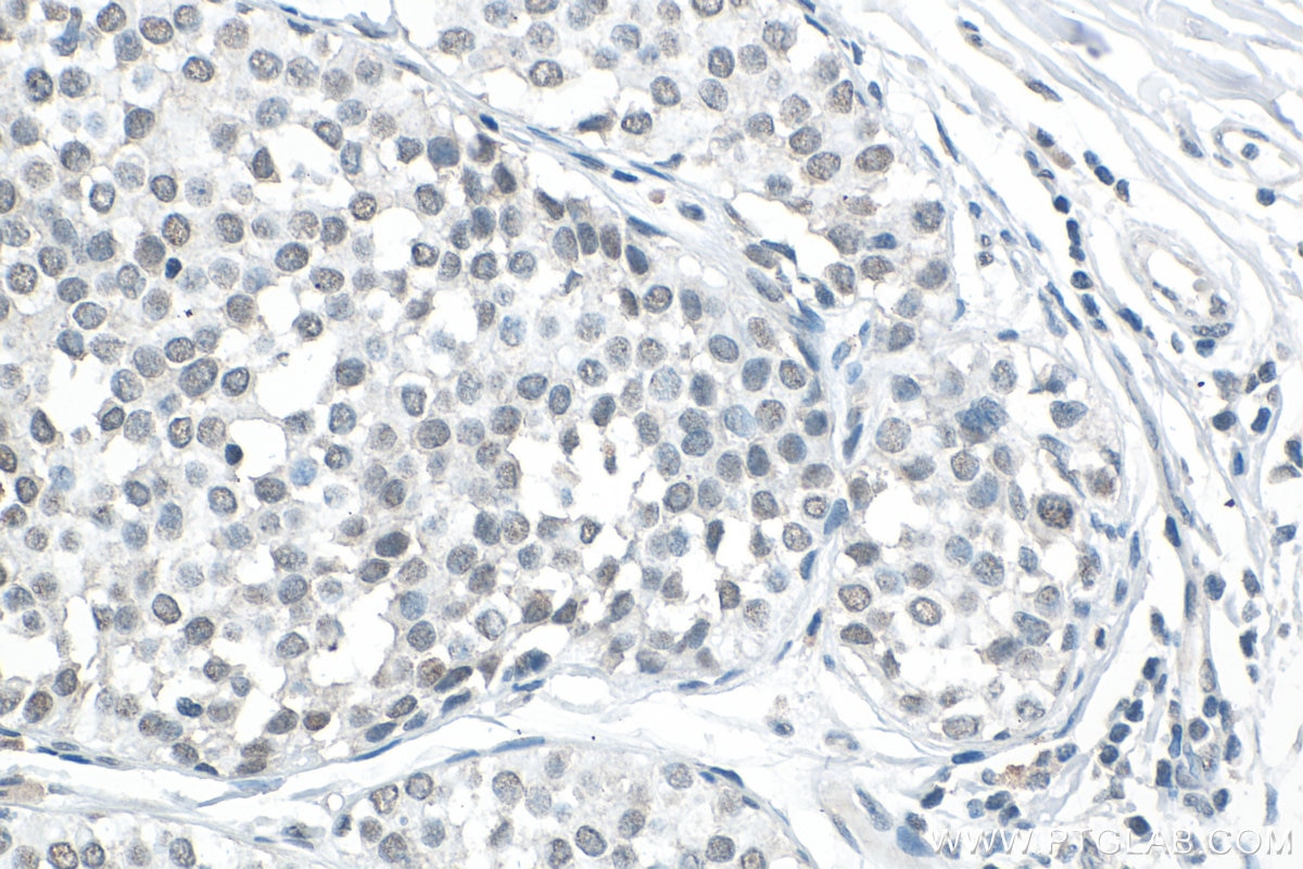 Immunohistochemistry (IHC) staining of human breast cancer tissue using USP10 Polyclonal antibody (19374-1-AP)