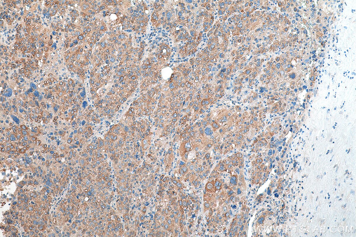 Immunohistochemistry (IHC) staining of human liver cancer tissue using USP10 Monoclonal antibody (67917-1-Ig)