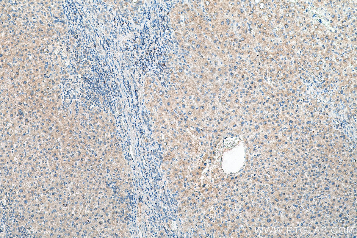 Immunohistochemistry (IHC) staining of human liver cancer tissue using USP10 Monoclonal antibody (67917-1-Ig)