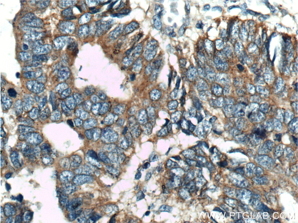 Immunohistochemistry (IHC) staining of human colon cancer tissue using USP11 Polyclonal antibody (10244-1-AP)