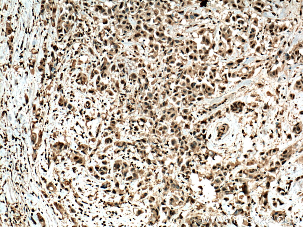 Immunohistochemistry (IHC) staining of human breast cancer tissue using USP11 Polyclonal antibody (22340-1-AP)
