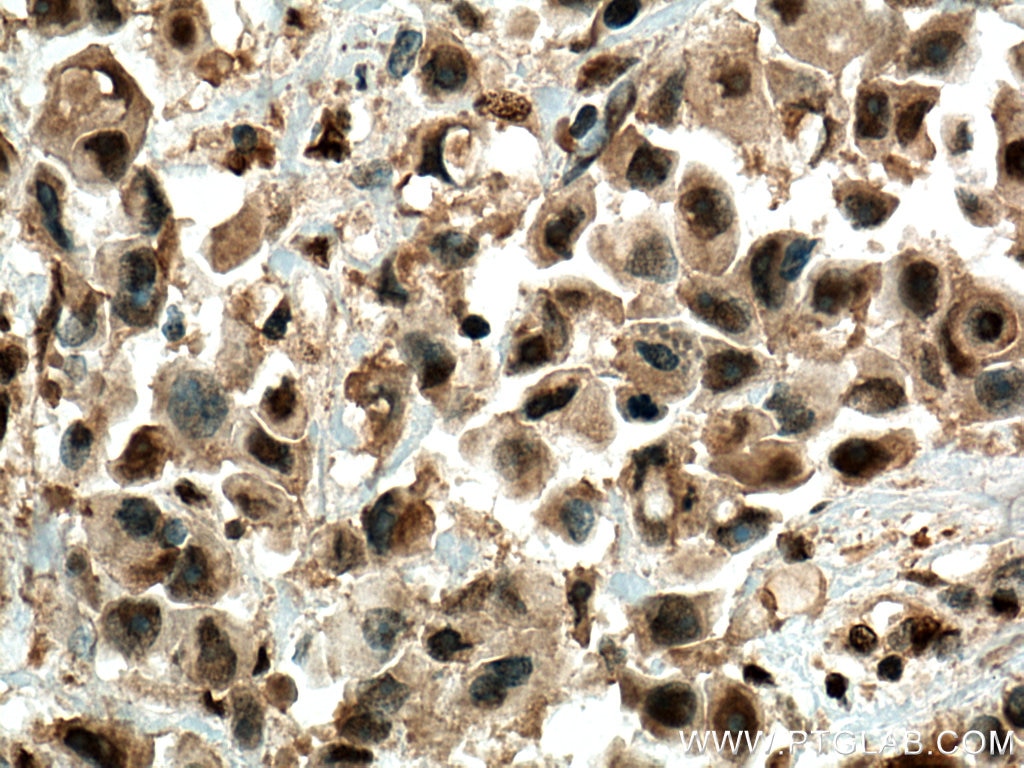 Immunohistochemistry (IHC) staining of human breast cancer tissue using USP11 Polyclonal antibody (22340-1-AP)