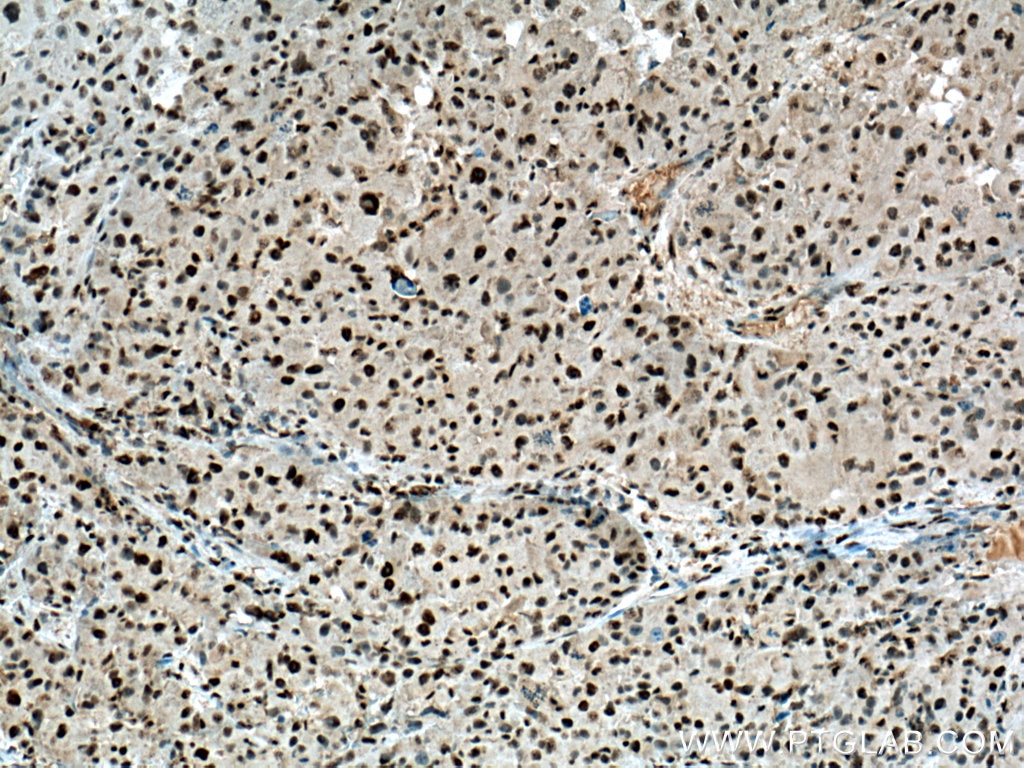 Immunohistochemistry (IHC) staining of human liver cancer tissue using USP11 Polyclonal antibody (22340-1-AP)