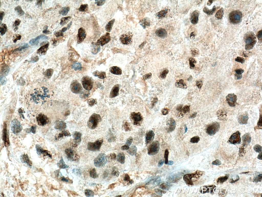 Immunohistochemistry (IHC) staining of human liver cancer tissue using USP11 Polyclonal antibody (22340-1-AP)