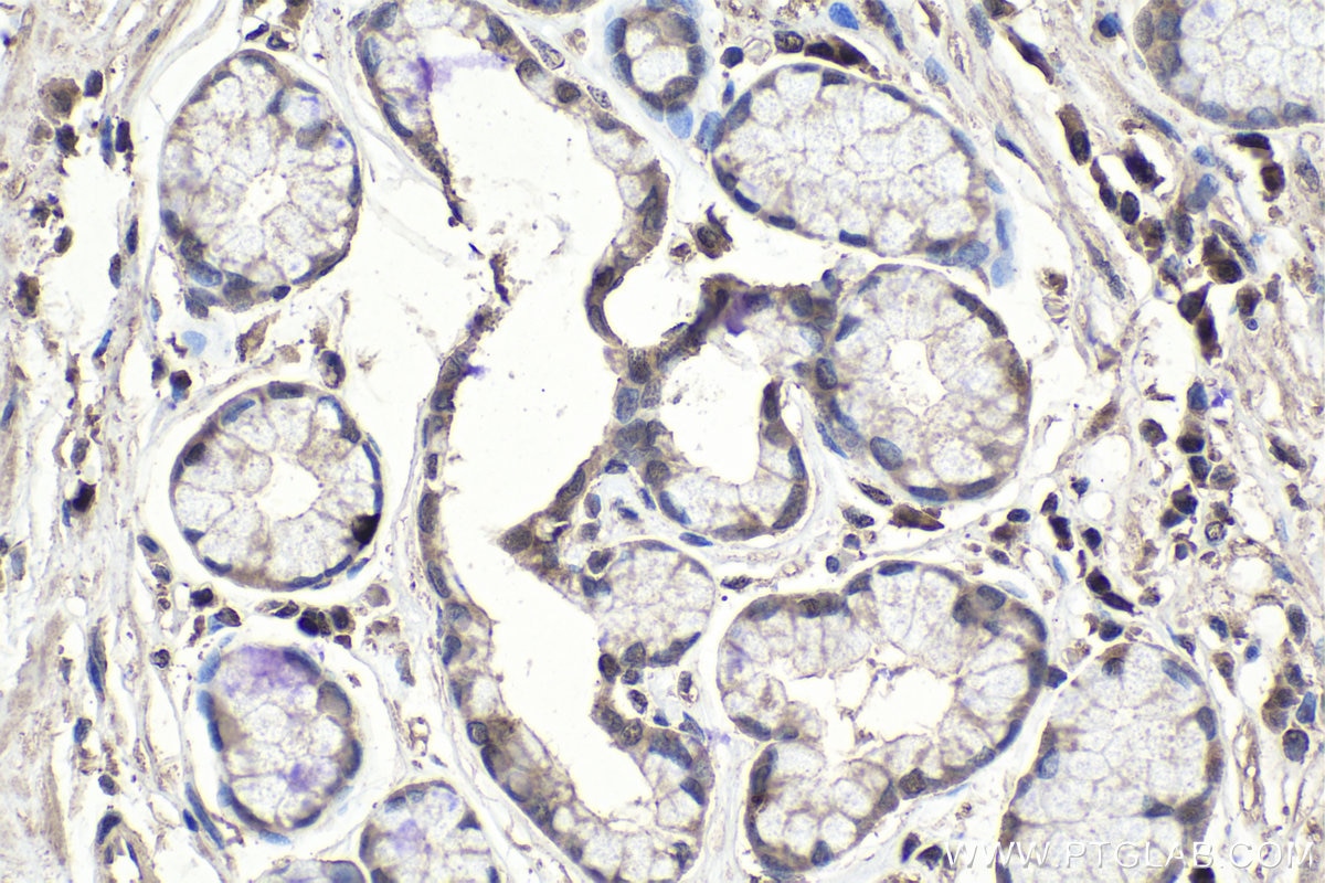 Immunohistochemistry (IHC) staining of human stomach cancer tissue using USP11 Monoclonal antibody (67805-1-Ig)