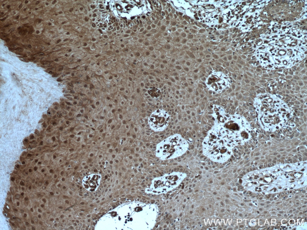 Immunohistochemistry (IHC) staining of human skin cancer tissue using USP13 Polyclonal antibody (16840-1-AP)