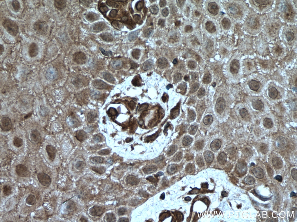 Immunohistochemistry (IHC) staining of human skin cancer tissue using USP13 Polyclonal antibody (16840-1-AP)