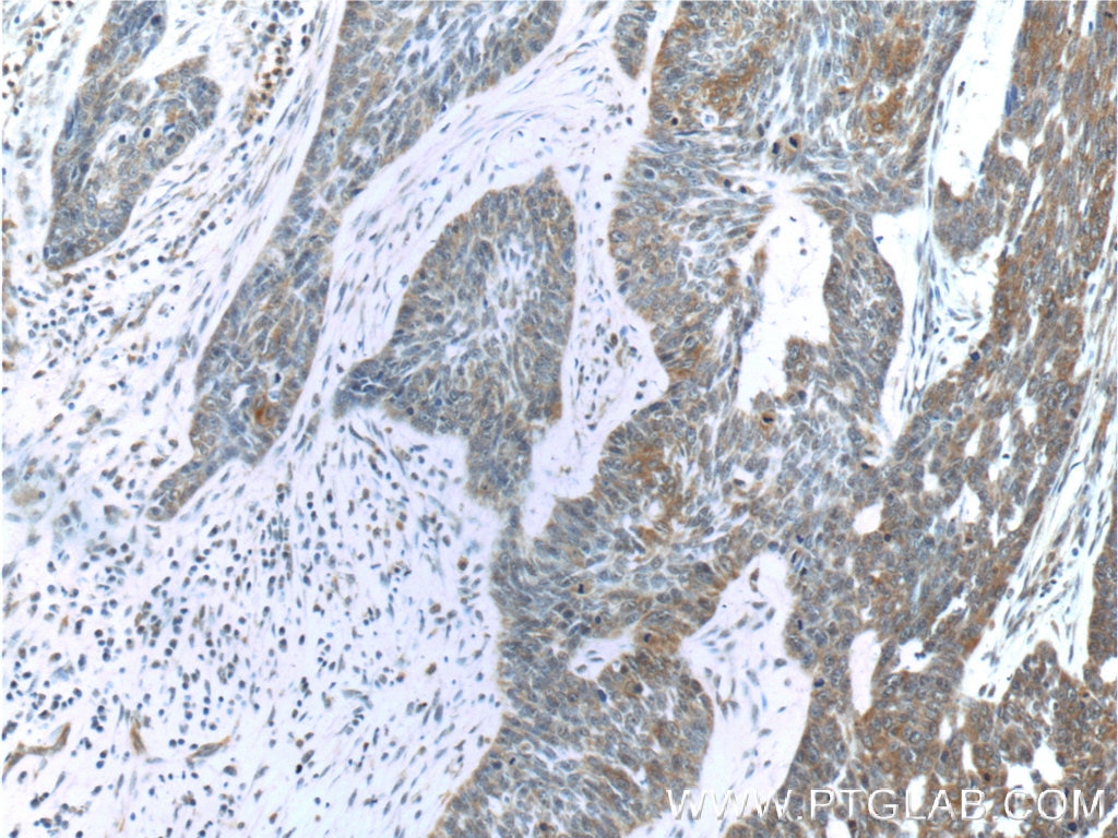 Immunohistochemistry (IHC) staining of human skin cancer tissue using USP13 Monoclonal antibody (66176-1-Ig)