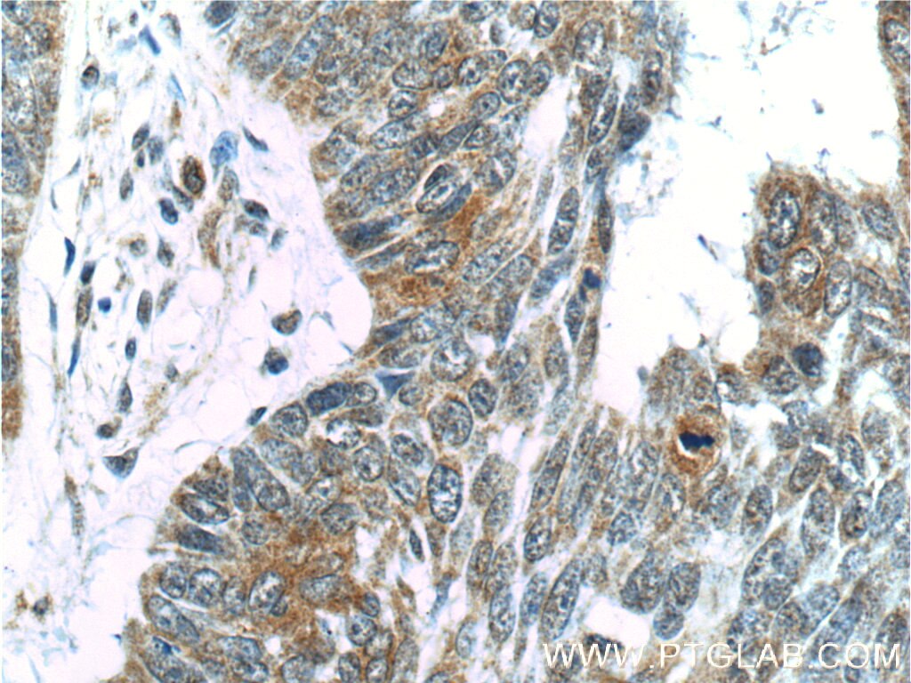 Immunohistochemistry (IHC) staining of human skin cancer tissue using USP13 Monoclonal antibody (66176-1-Ig)