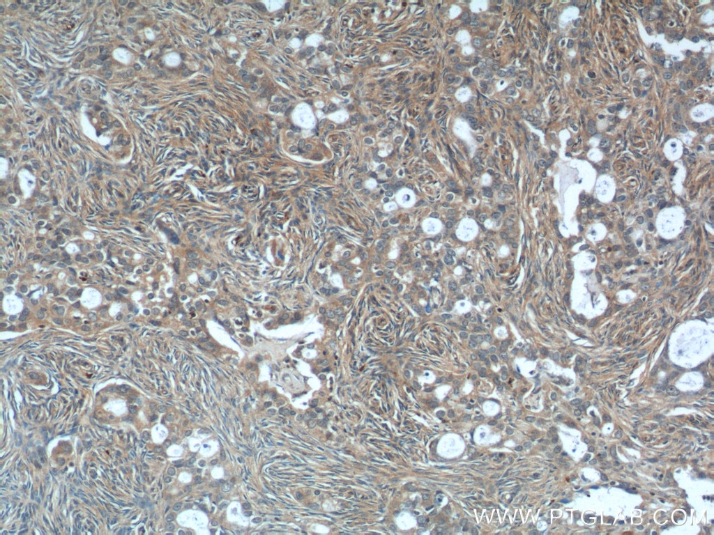 Immunohistochemistry (IHC) staining of human ovary tumor tissue using USP15 Polyclonal antibody (14354-1-AP)