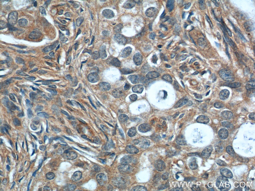 IHC staining of human ovary tumor using 14354-1-AP