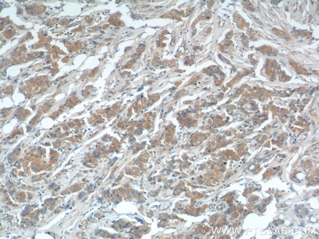 Immunohistochemistry (IHC) staining of human breast cancer tissue using USP15 Polyclonal antibody (14354-1-AP)