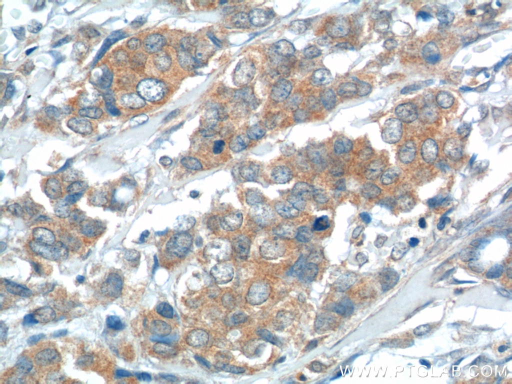 Immunohistochemistry (IHC) staining of human breast cancer tissue using USP15 Polyclonal antibody (14354-1-AP)