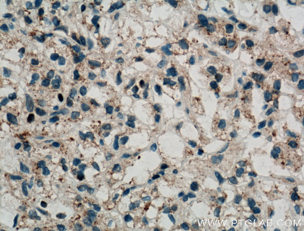 Immunohistochemistry (IHC) staining of human renal cell carcinoma tissue using USP15 Polyclonal antibody (14354-1-AP)