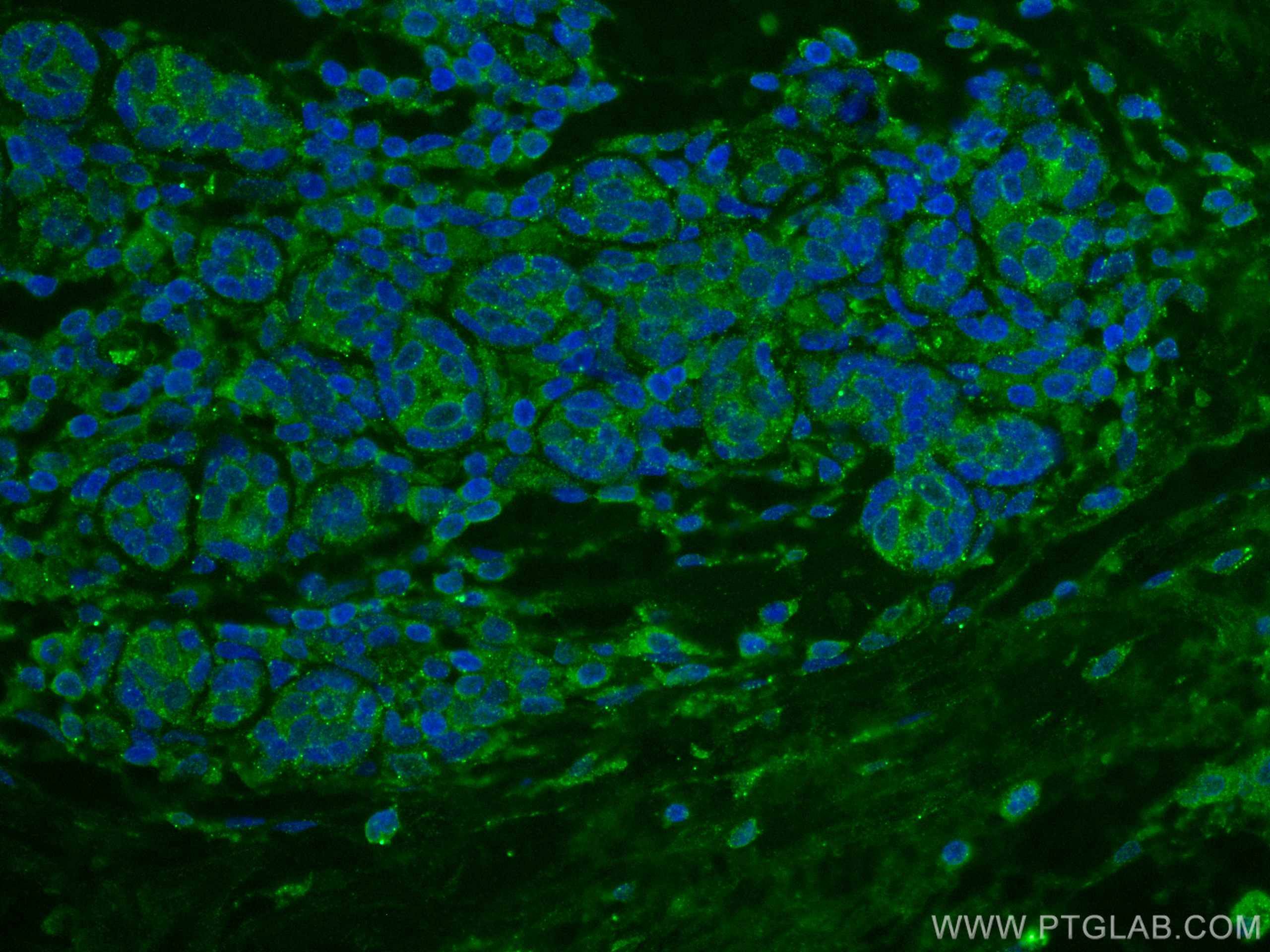 Immunofluorescence (IF) / fluorescent staining of human breast cancer tissue using USP15 Monoclonal antibody (67557-1-Ig)