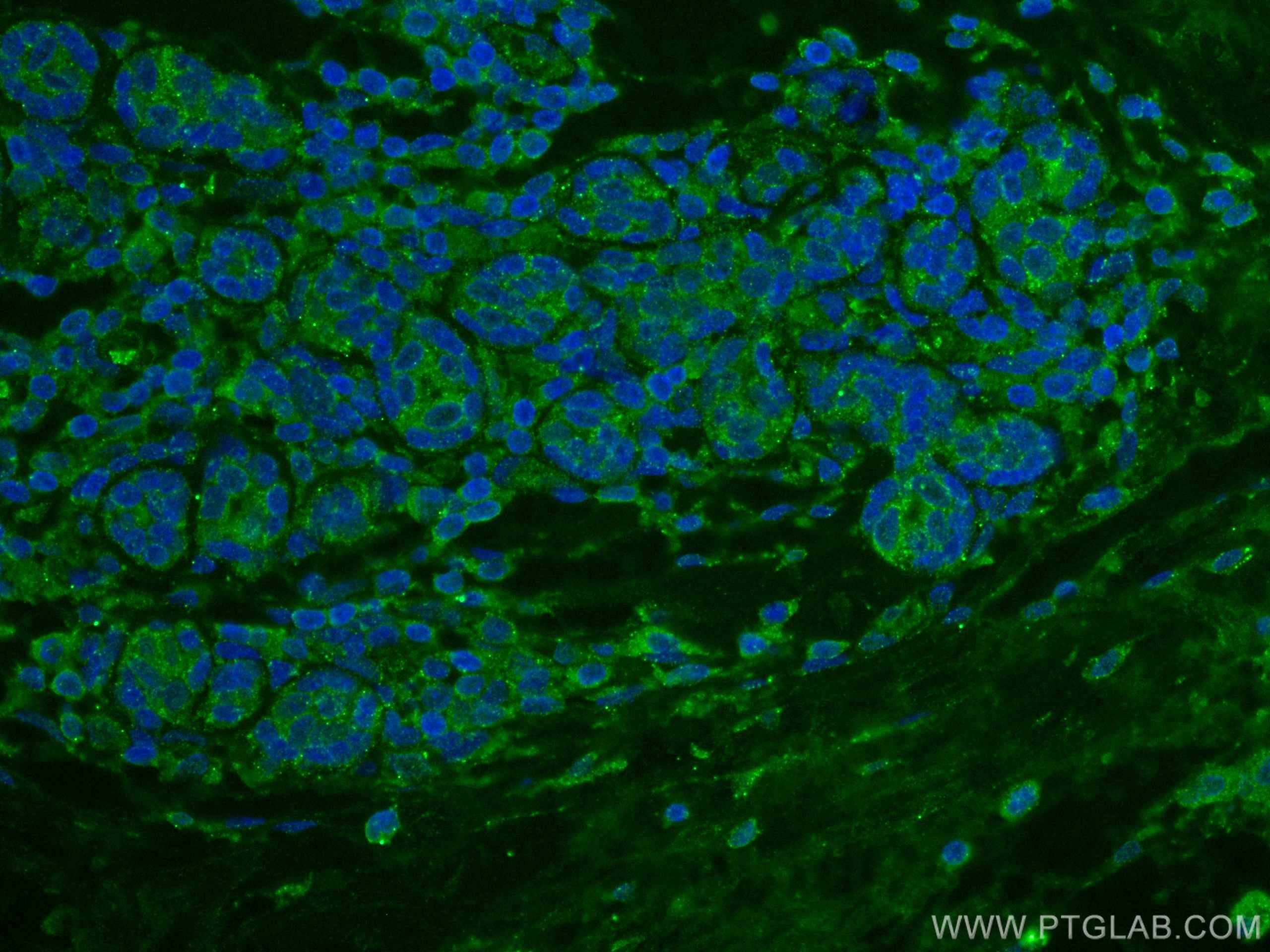 IF Staining of human breast cancer using 67557-1-Ig