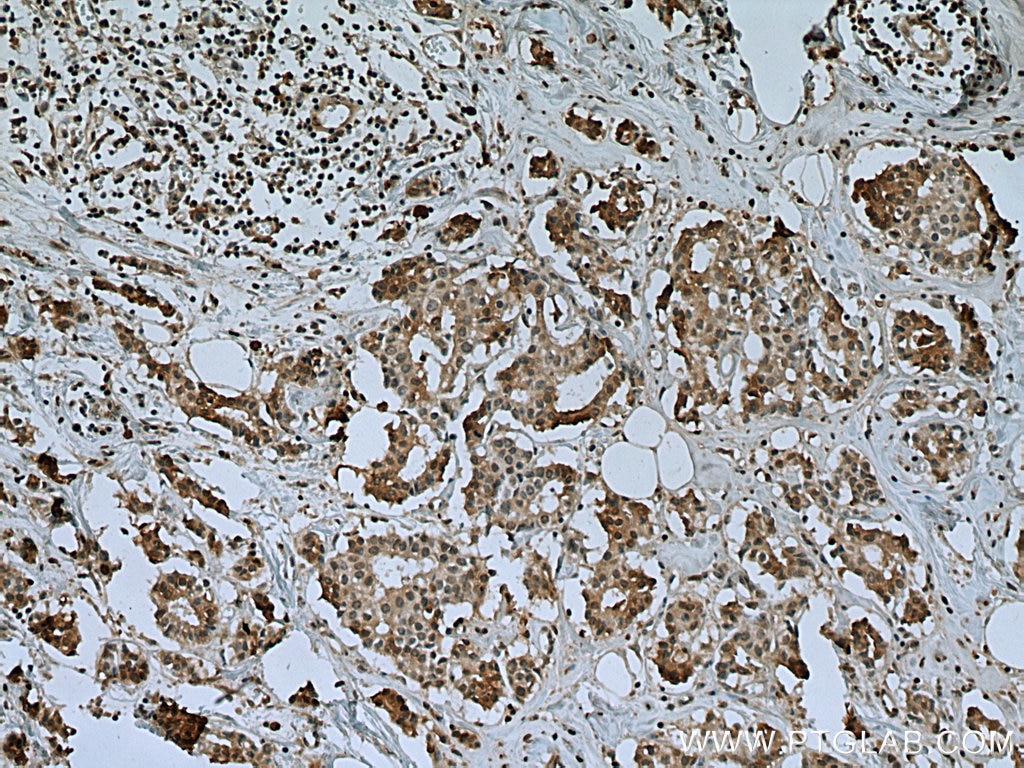 Immunohistochemistry (IHC) staining of human breast cancer tissue using USP15 Monoclonal antibody (67557-1-Ig)