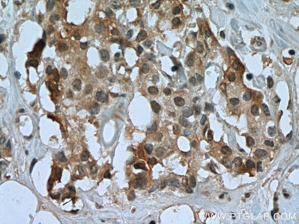 Immunohistochemistry (IHC) staining of human breast cancer tissue using USP15 Monoclonal antibody (67557-1-Ig)