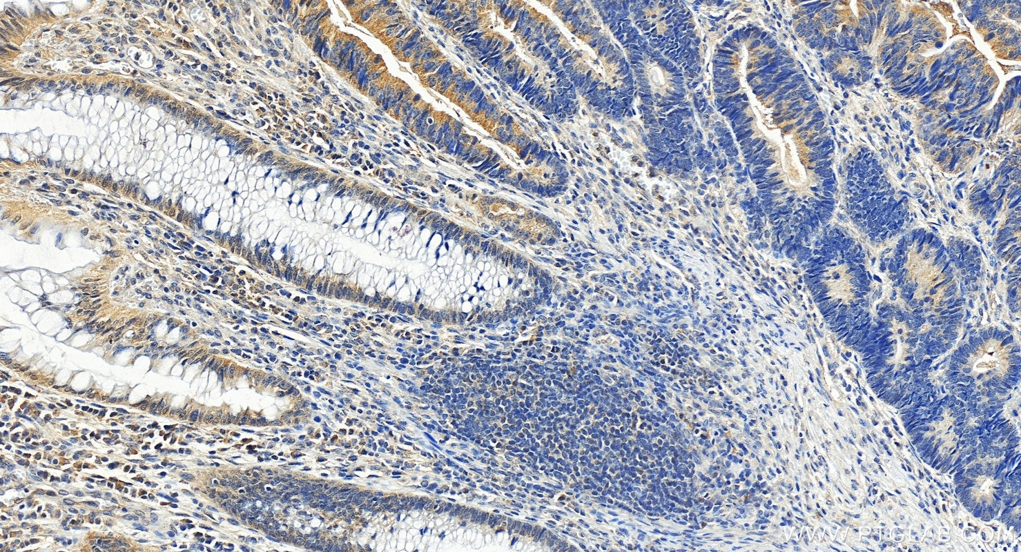 Immunohistochemistry (IHC) staining of human colon cancer tissue using USP18 Polyclonal antibody (12153-1-AP)