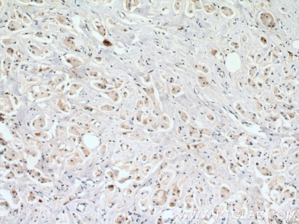 Immunohistochemistry (IHC) staining of human breast cancer tissue using USP2 Polyclonal antibody (10392-1-AP)