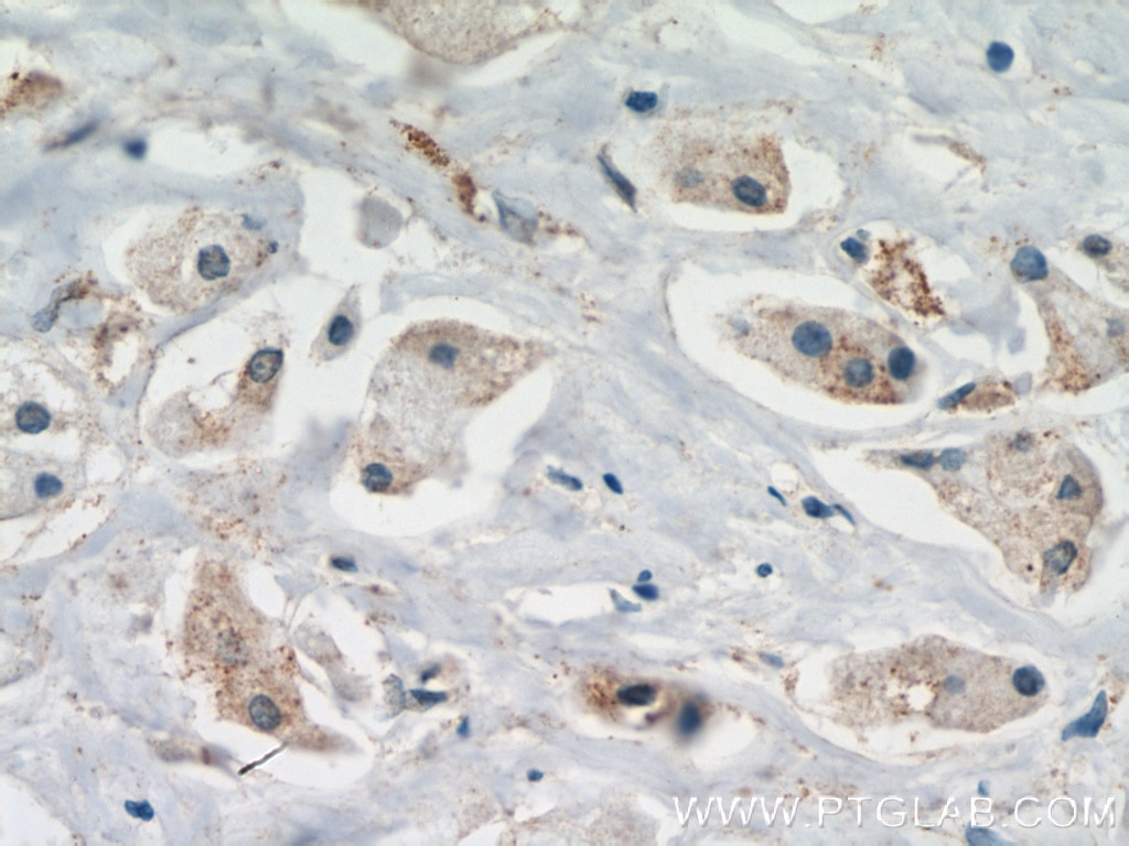 Immunohistochemistry (IHC) staining of human breast cancer tissue using USP2 Polyclonal antibody (10392-1-AP)