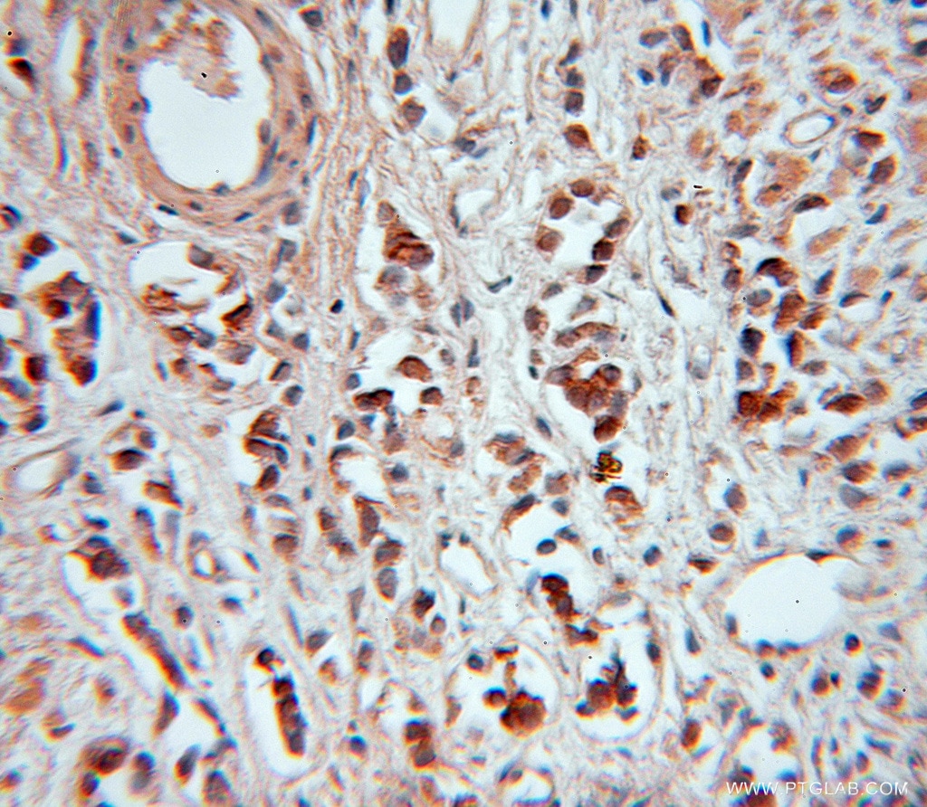 Immunohistochemistry (IHC) staining of human prostate cancer tissue using USP2 Polyclonal antibody (10392-1-AP)