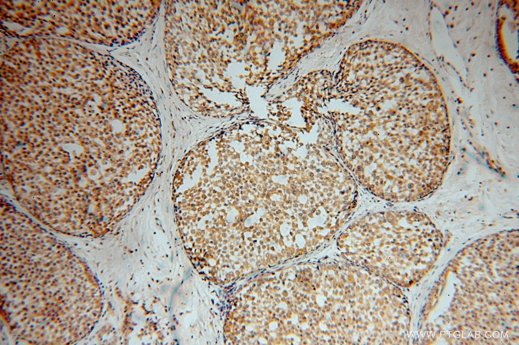 Immunohistochemistry (IHC) staining of human breast cancer tissue using USP2 Polyclonal antibody (10392-1-AP)