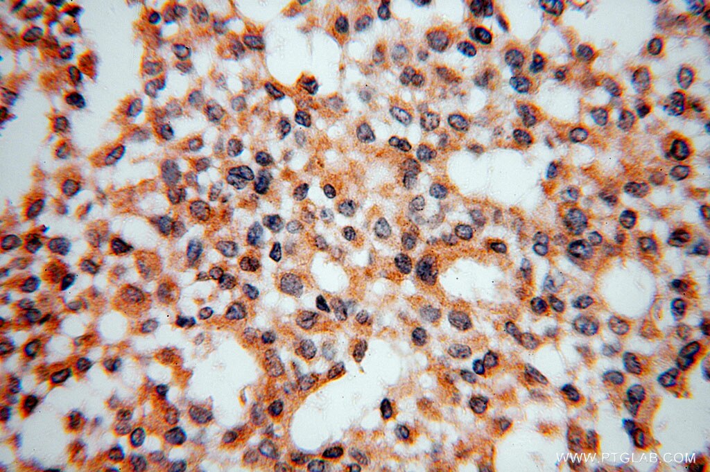 Immunohistochemistry (IHC) staining of human breast cancer tissue using USP2 Polyclonal antibody (10392-1-AP)