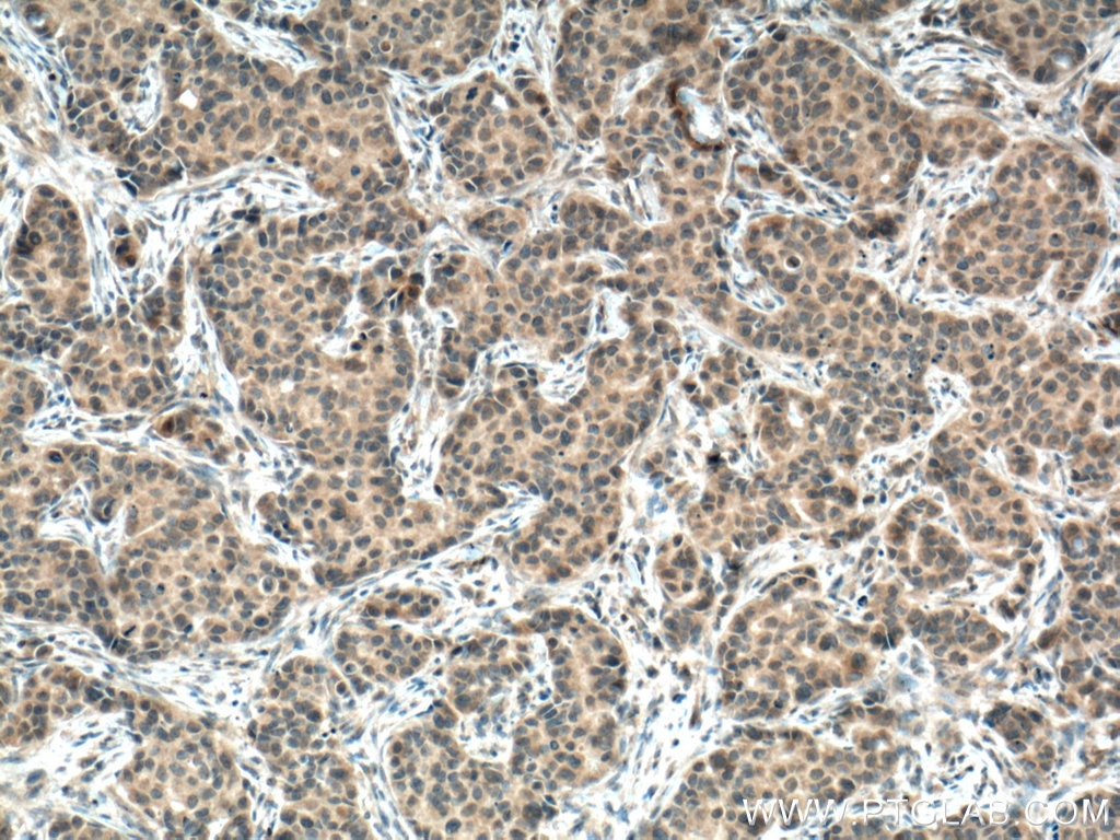 Immunohistochemistry (IHC) staining of human breast cancer tissue using USP21 Polyclonal antibody (17856-1-AP)