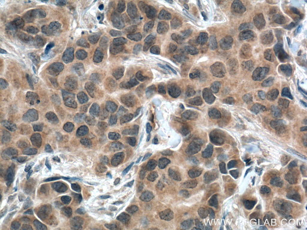 Immunohistochemistry (IHC) staining of human breast cancer tissue using USP21 Polyclonal antibody (17856-1-AP)