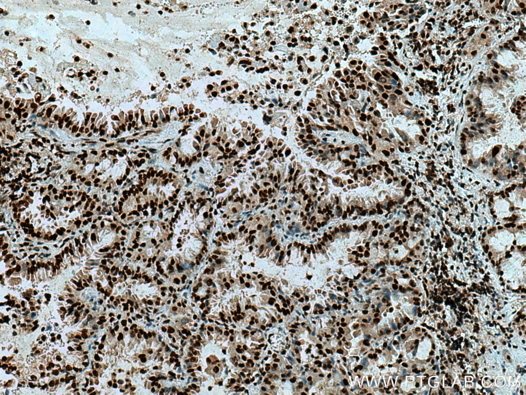 Immunohistochemistry (IHC) staining of human lung cancer tissue using USP22 Polyclonal antibody (55110-1-AP)