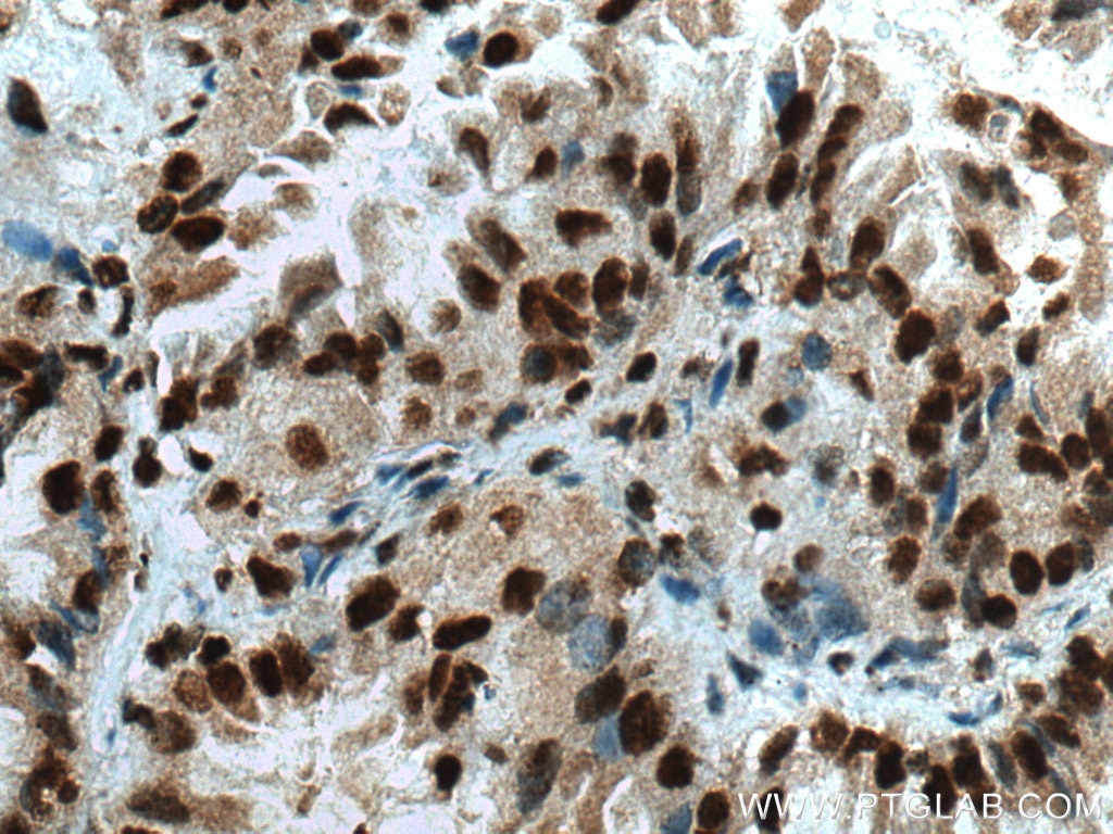 Immunohistochemistry (IHC) staining of human lung cancer tissue using USP22 Polyclonal antibody (55110-1-AP)