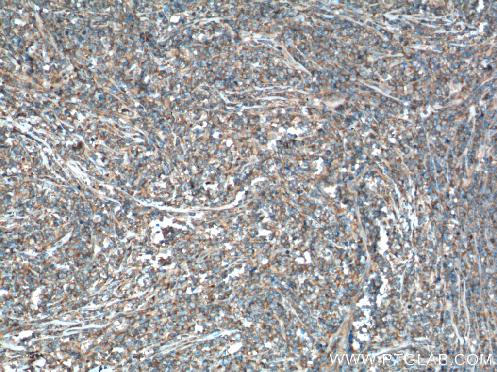 Immunohistochemistry (IHC) staining of human lymphoma tissue using USP24 Polyclonal antibody (13126-1-AP)
