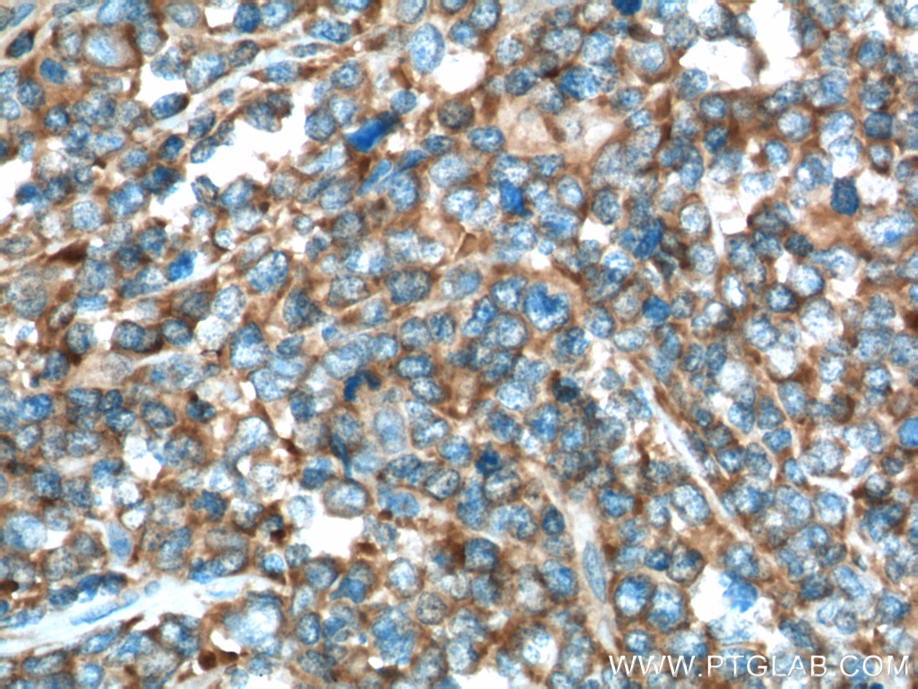 Immunohistochemistry (IHC) staining of human lymphoma tissue using USP24 Polyclonal antibody (13126-1-AP)
