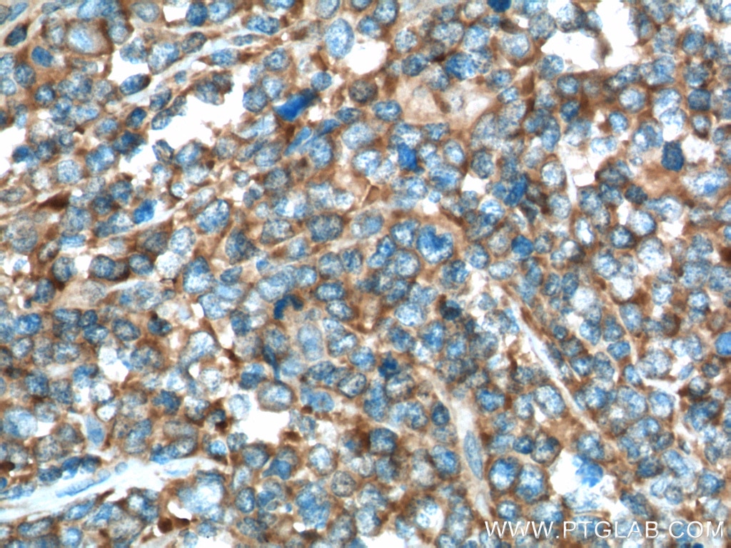 IHC staining of human lymphoma using 13126-1-AP