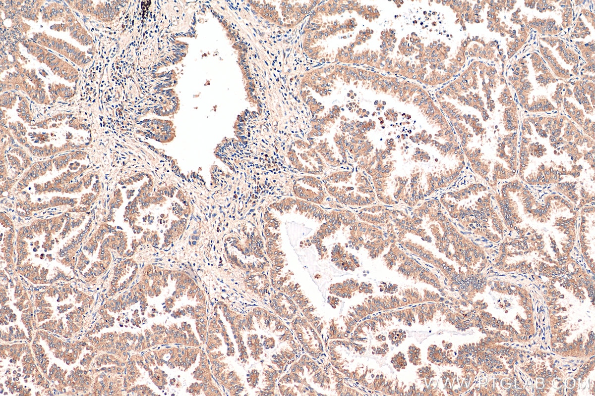 Immunohistochemistry (IHC) staining of human lung cancer tissue using USP25 Polyclonal antibody (12199-1-AP)