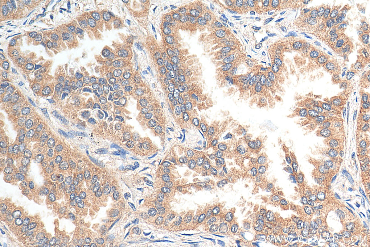 Immunohistochemistry (IHC) staining of human lung cancer tissue using USP25 Polyclonal antibody (12199-1-AP)