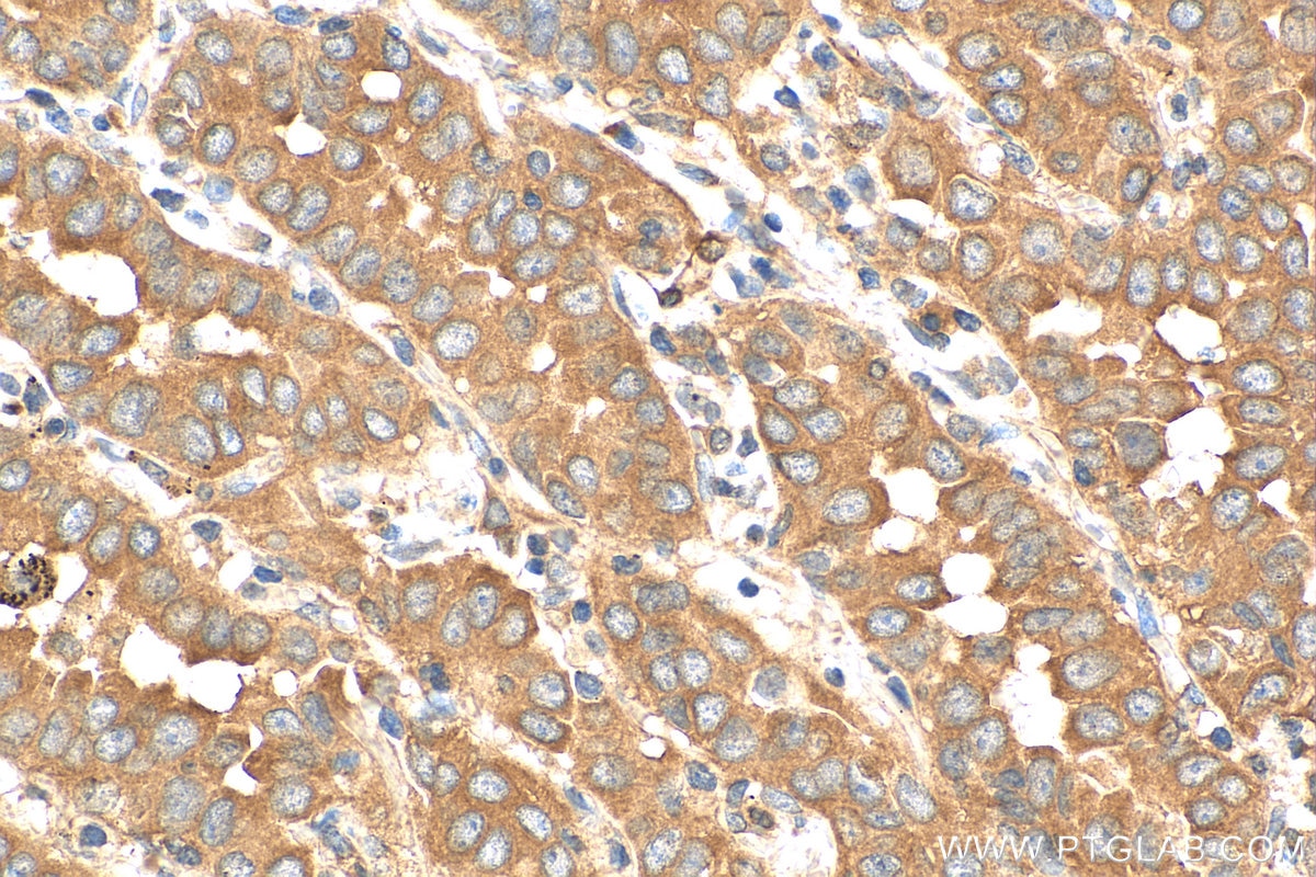 Immunohistochemistry (IHC) staining of human lung cancer tissue using USP25 Polyclonal antibody (28817-1-AP)