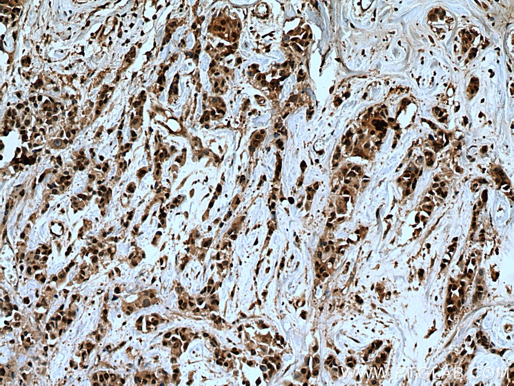 Immunohistochemistry (IHC) staining of human breast cancer tissue using USP28 Polyclonal antibody (17707-1-AP)