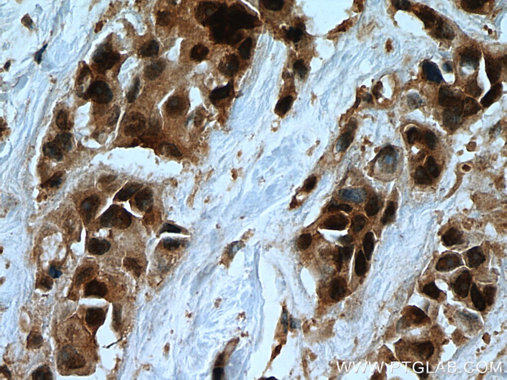 Immunohistochemistry (IHC) staining of human breast cancer tissue using USP28 Polyclonal antibody (17707-1-AP)