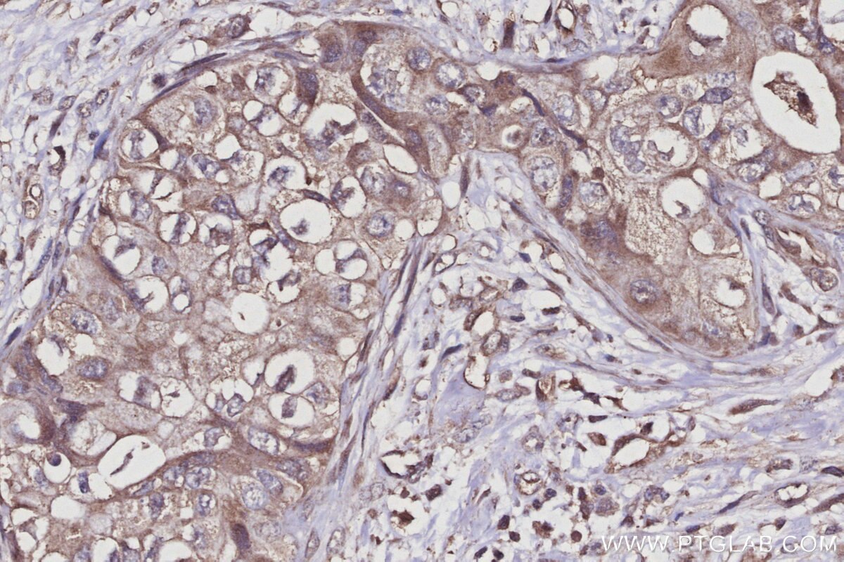 IHC staining of human pancreas cancer using 27522-1-AP Immunohistochemistry (IHC) staining of human pancreas cancer tissue using USP29 Polyclonal antibody (27522-1-AP)