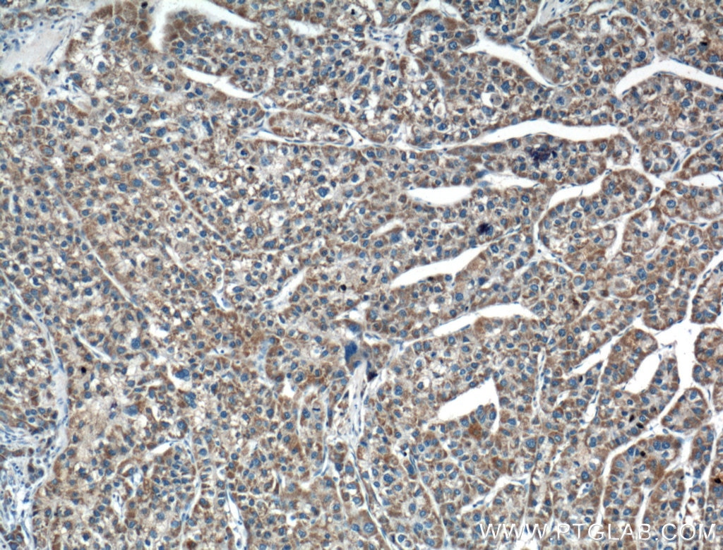 Immunohistochemistry (IHC) staining of human liver cancer tissue using USP30 Polyclonal antibody (15402-1-AP)