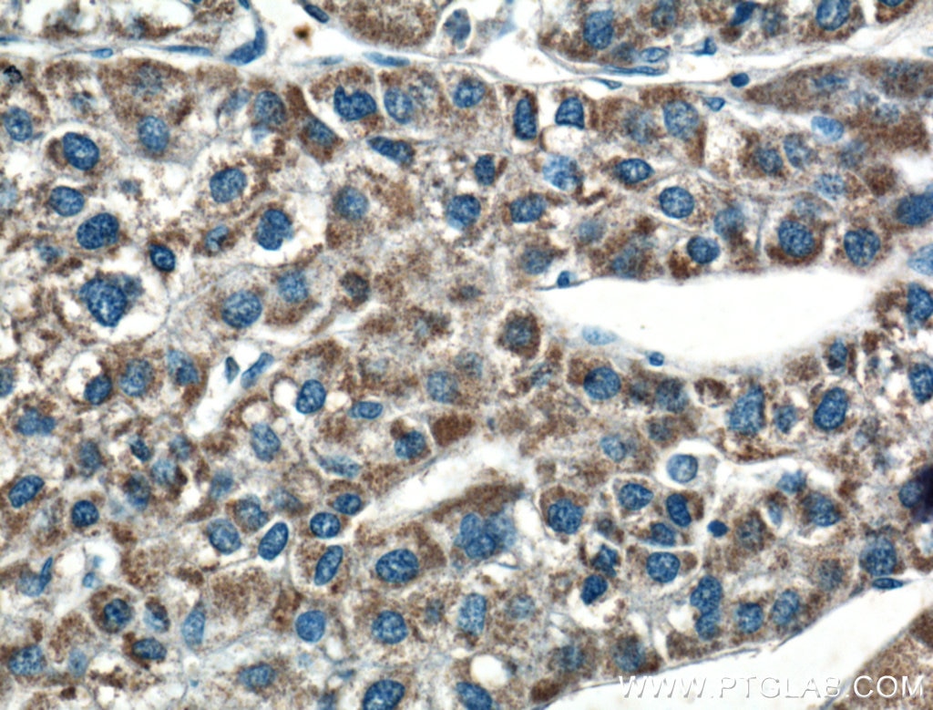 Immunohistochemistry (IHC) staining of human liver cancer tissue using USP30 Polyclonal antibody (15402-1-AP)